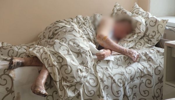 Опіки і вибухові травми. Лікарі розповіли про стан пацієнтів Вінницької обласної лікарні                    
