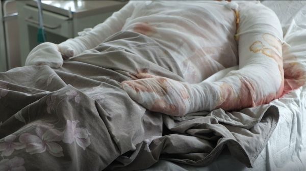 Опіки і вибухові травми. Лікарі розповіли про стан пацієнтів Вінницької обласної лікарні                    
