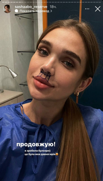 Саша Бо показала результат операції на губах